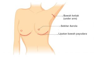 operasi pembesaran payudara dengan implant