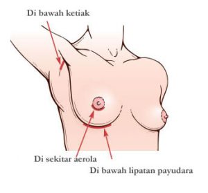 Sayatan operasi implant payudara