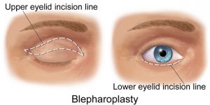 Operasi kelopak mata Blepharoplasty