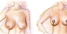 Pengecilan Payudara – Breast Reduction