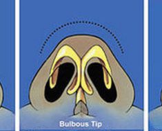 Memancungkan Hidung – Rhinoplasty