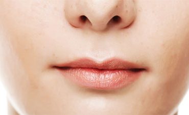 Lip reduction membentuk bibir